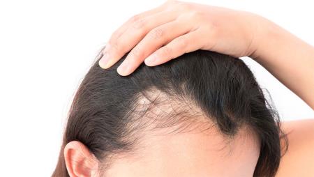 Come combattere la calvizia maschile e femminile