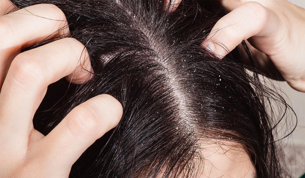 Come eliminare la forfora dai capelli: cause e rimedi al problema